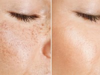 SOS manchas: cómo combatir la hiperpigmentación de forma efectiva