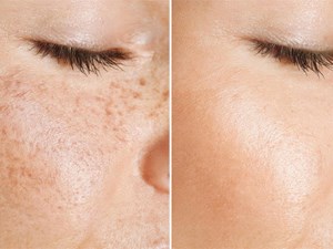 SOS manchas: cómo combatir la hiperpigmentación de forma efectiva